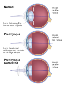 Denver Presbyopia | Age-Related Near Vision Loss Northglenn CO